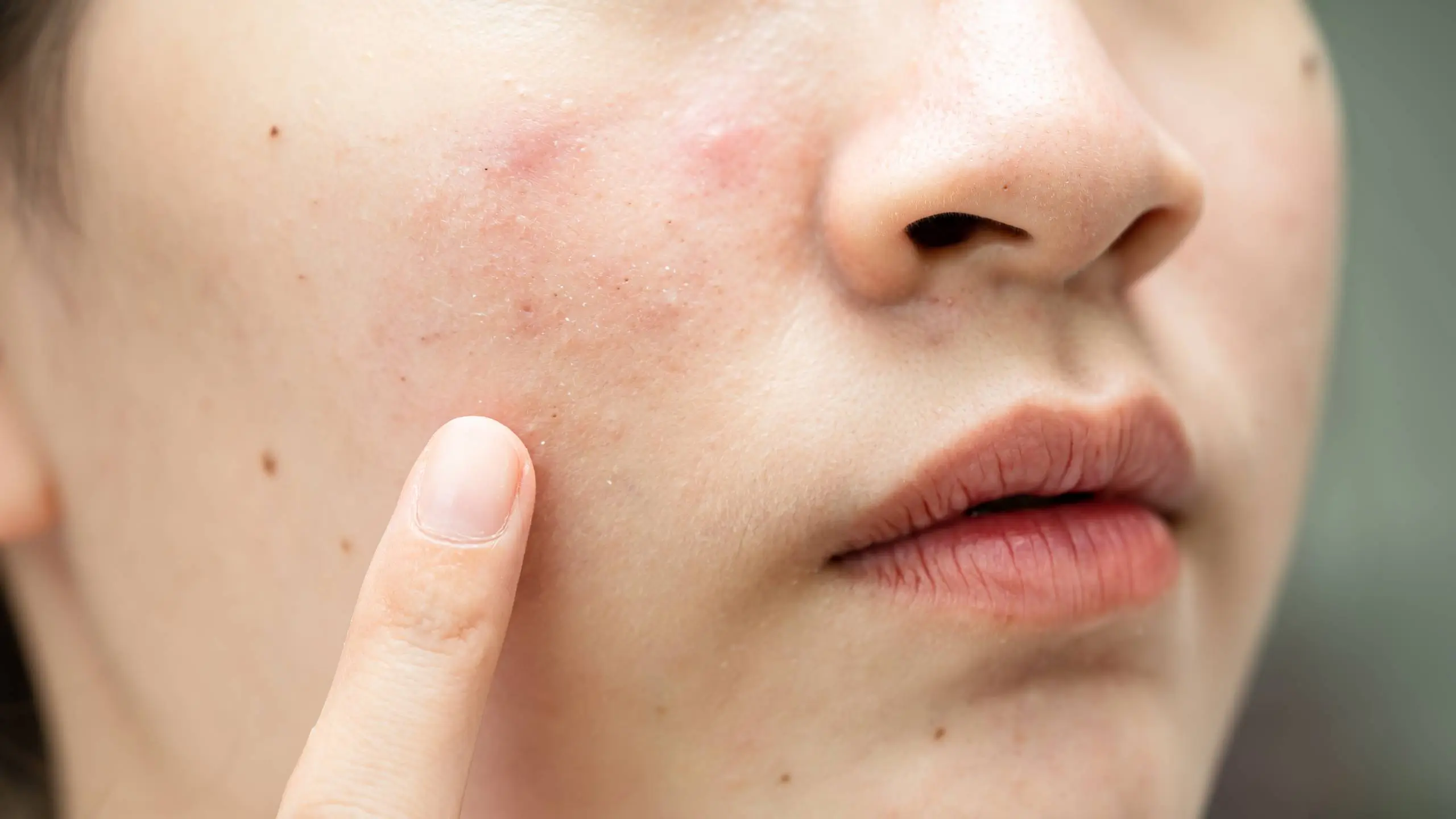 Why Facial Infections Spread to the Cavernous Sinus